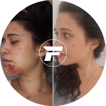 A woman with acne and acne scars on her face.