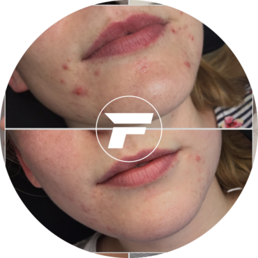 A woman 's face with acne and a round image of the same.