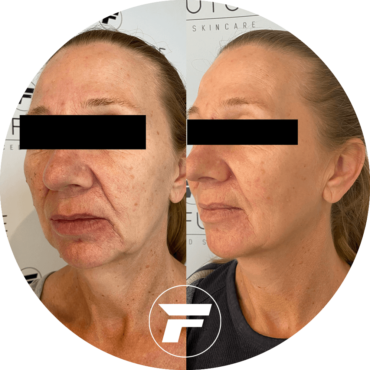 A woman with wrinkles and aging is shown before and after her treatment.