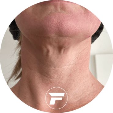 A woman 's neck with an image of the face in front.